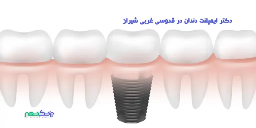 دکتر ایمپلنت دندان در قدوسی غربی شیراز