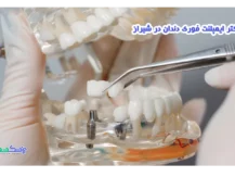 دکتر ایمپلنت فوری دندان در شیراز