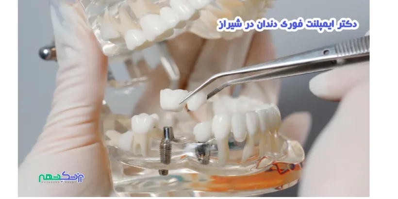 دکتر ایمپلنت فوری دندان در شیراز