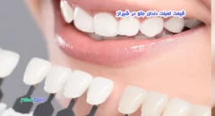 قیمت لمینت دندان جلو در شیراز