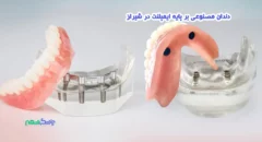 دندان مصنوعی بر پایه ایمپلنت در شیراز