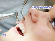 دکتر پولیش دندان در شیراز