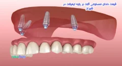 قیمت دندان مصنوعی ثابت بر پایه ایمپلنت در شیراز