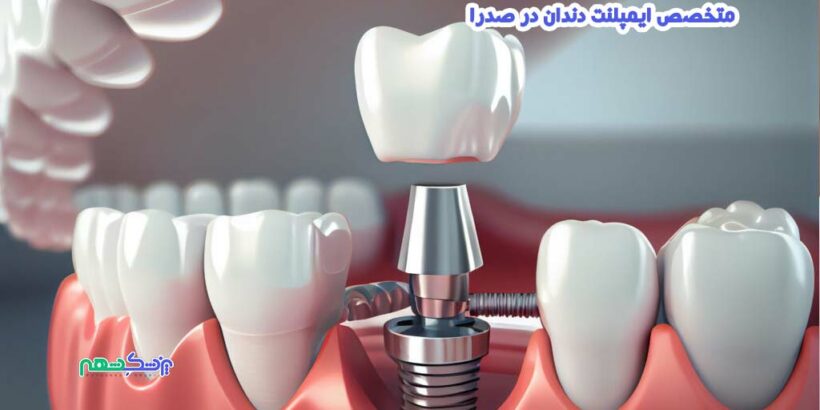 متخصص ایمپلنت دندان در صدرا