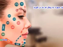 لیفت صورت به روش ام دی در شیراز (MD codes)