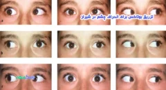 تزریق بوتاکس برای انحراف چشم در شیراز