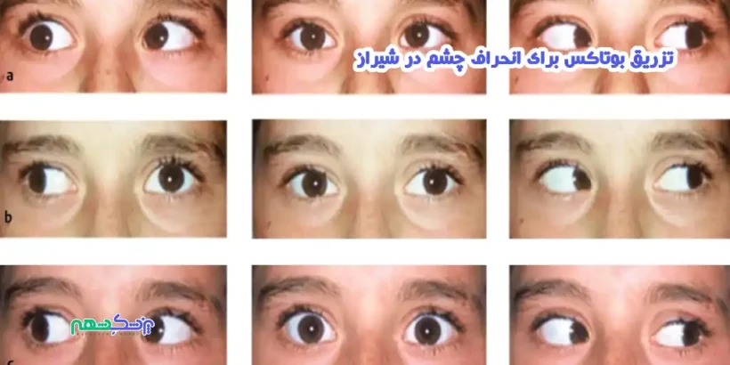 تزریق بوتاکس برای انحراف چشم در شیراز
