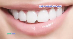 ترمیم دندان شکسته در شیراز