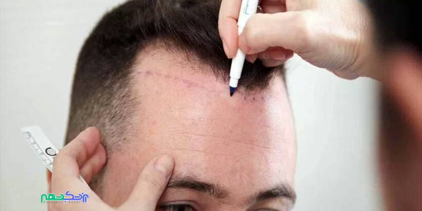 آیا کاشت مو ضرر دارد؟ همه چیز درباره ضررهای کاشت مو