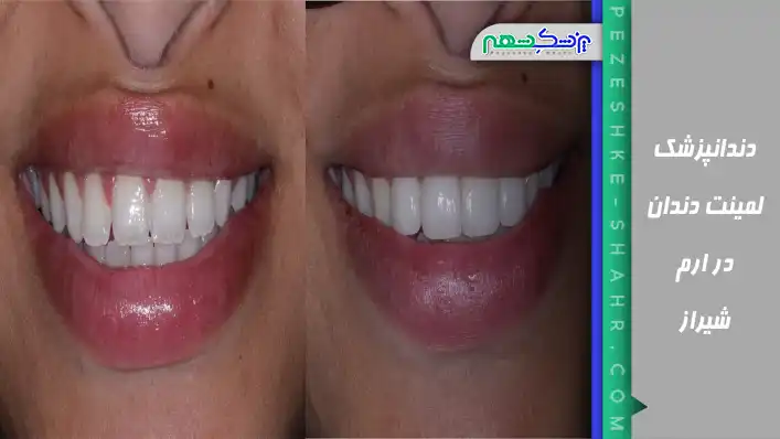 دندانپزشک لمینت دندان در ارم شیراز