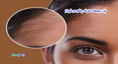 لیزر موهای اطراف چشم در شیراز