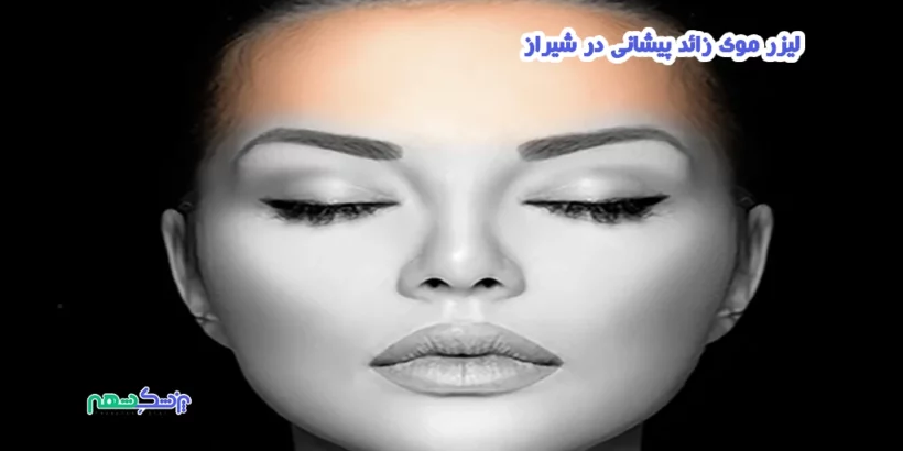 لیزر موی زائد پیشانی در شیراز
