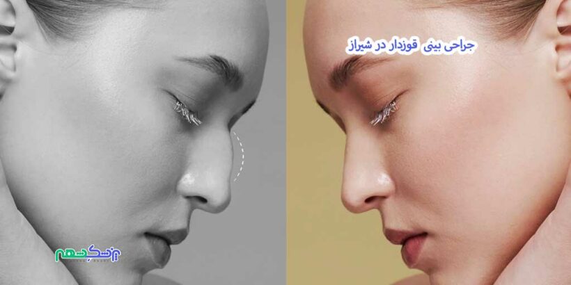 جراحی بینی قوزدار در شیراز