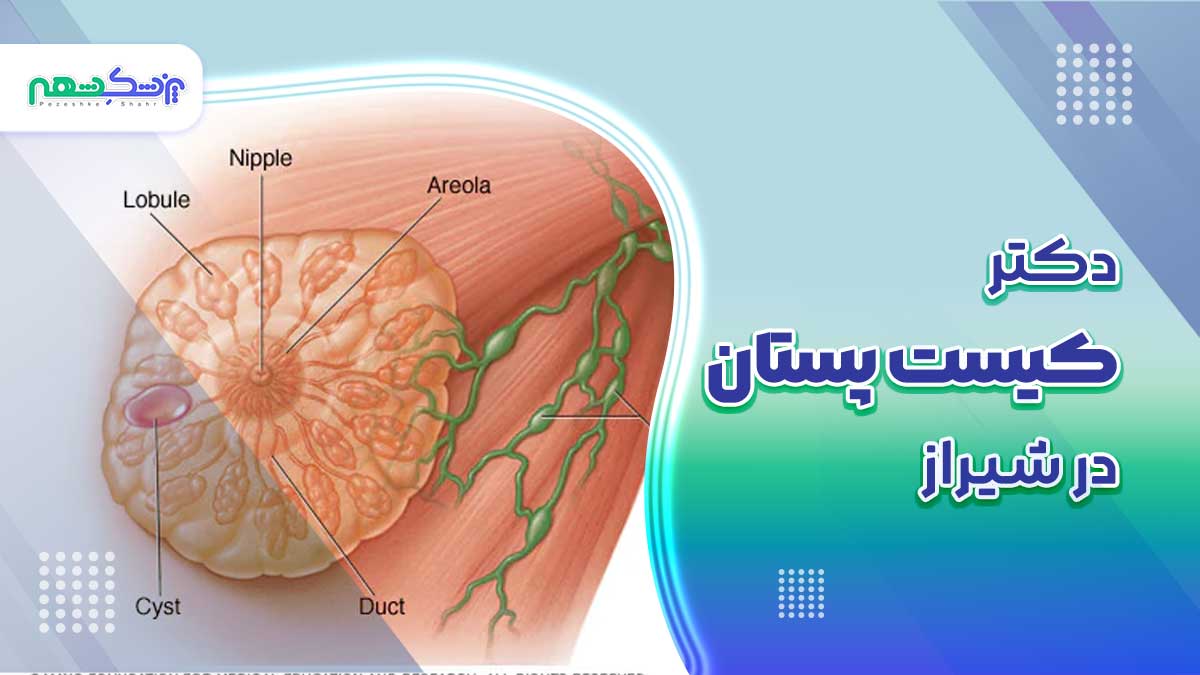 دکتر کیست پستان در شیراز